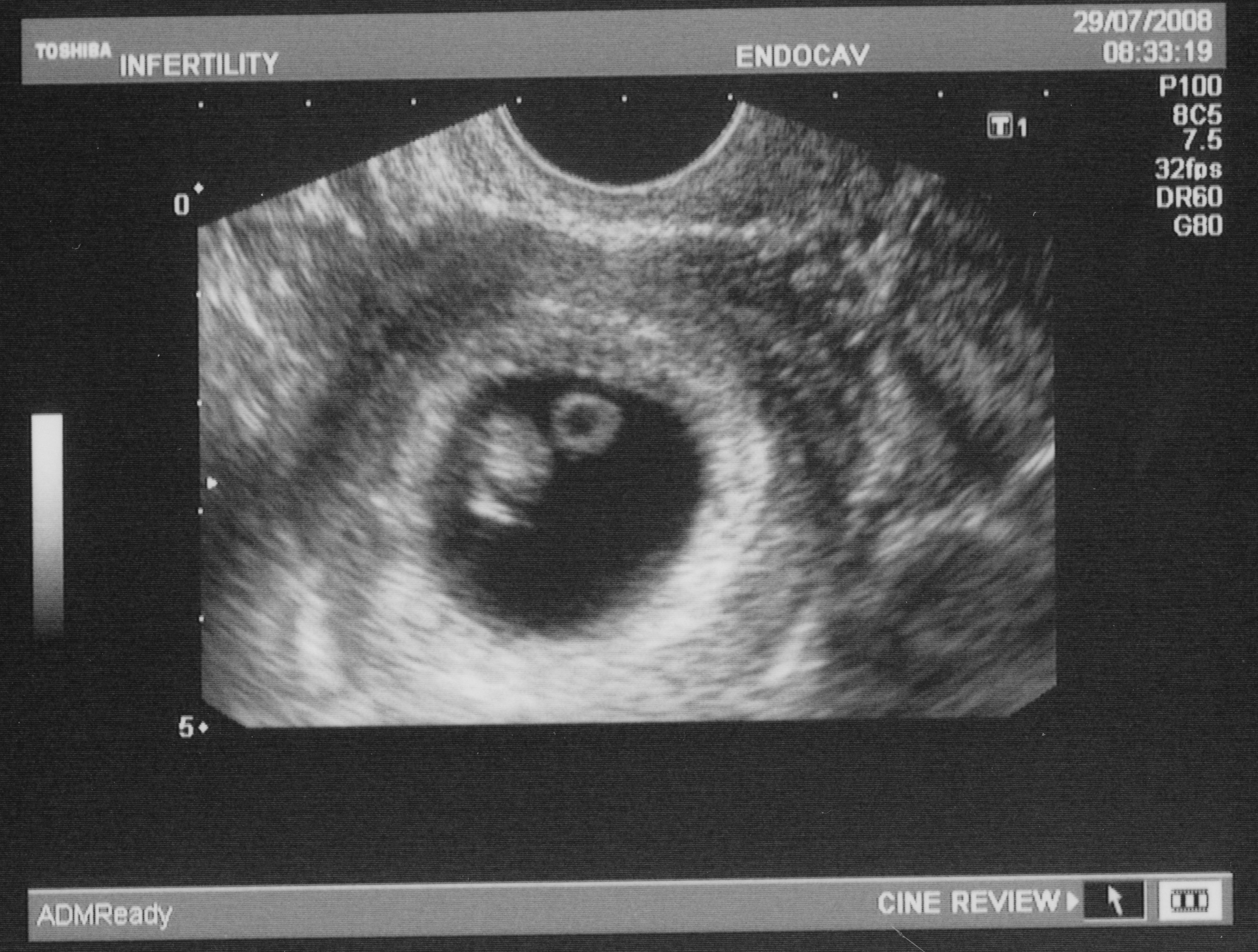 Фото узи на 5 неделе. УЗИ 7-8 недель беременности двойня. УЗИ двойни однояйцевые. УЗИ 5-6 недель беременности двойня.
